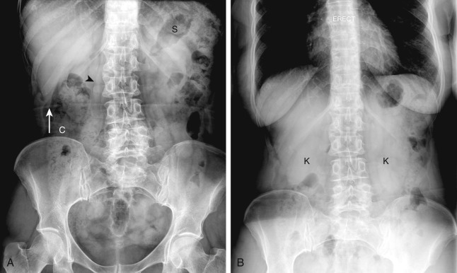 Figure 23-1, Normal plain radiograph of abdomen. A, Frontal radiograph performed with patient in supine position. Lower ribs, lumbar spine, pelvis, and femoral heads have bone density. Stomach ( S ), seen under left hemidiaphragm, has air density. Right psoas margin ( arrowhead ) is seen because of interface of retroperitoneal fat and muscle soft tissue density. Tip of liver ( arrow ) is demonstrated because gas in hepatic flexure abuts soft tissue density of liver tip, creating interface. Feces in colon ( C ) has mottled density of soft tissue and gas. B, Frontal radiograph performed with patient in upright position. No air-fluid levels are seen, as there is no fluid in stomach or right colon. Kidneys ( K ) are outlined by interface of retroperitoneal fat and soft tissue of kidneys.