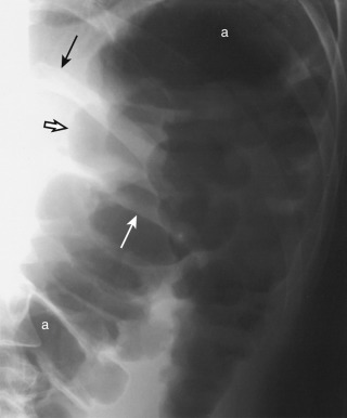 Figure 23-2, Coned-down plain abdominal radiograph of left upper quadrant obtained with patient standing. Air density ( a ) varies from black to gray. Bone density is shown in lower left ribs ( black arrow on left eleventh rib). The colon is identified by its air-filled haustral sacculations ( hollow black arrow ), interfaced with adjacent soft tissue density. Interhaustral folds of splenic flexure of colon are thick ( white arrow ) in this patient diagnosed with fulminant colitis (“toxic megacolon”). The interhaustral fold density is representative of soft tissue density.