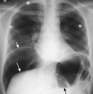 Figure 23-3, Free intraperitoneal gas on upright chest radiograph. Large amount of air density free intraperitoneal gas separates right hemidiaphragm ( small white arrow ) from superior edge of liver ( large white arrow ). Air-fluid level ( black arrow ) in small bowel loop reveals that this chest radiograph was obtained with patient in upright position.