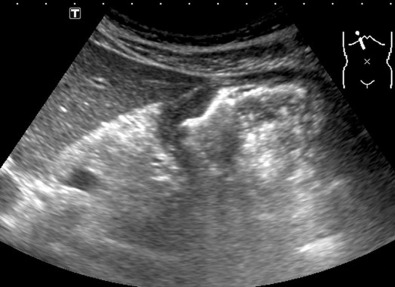 Figure 3-1, Gastric cancer. Gastric mural thickening demonstrated by 3.5-MHz curved probe.