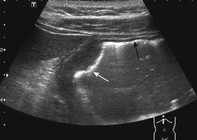 Figure 3-2, In the same patient, gastric mural thickening (white arrow) and normal gastric wall (black arrow) were demonstrated with greater spatial resolution using a 7.0-MHz linear probe.