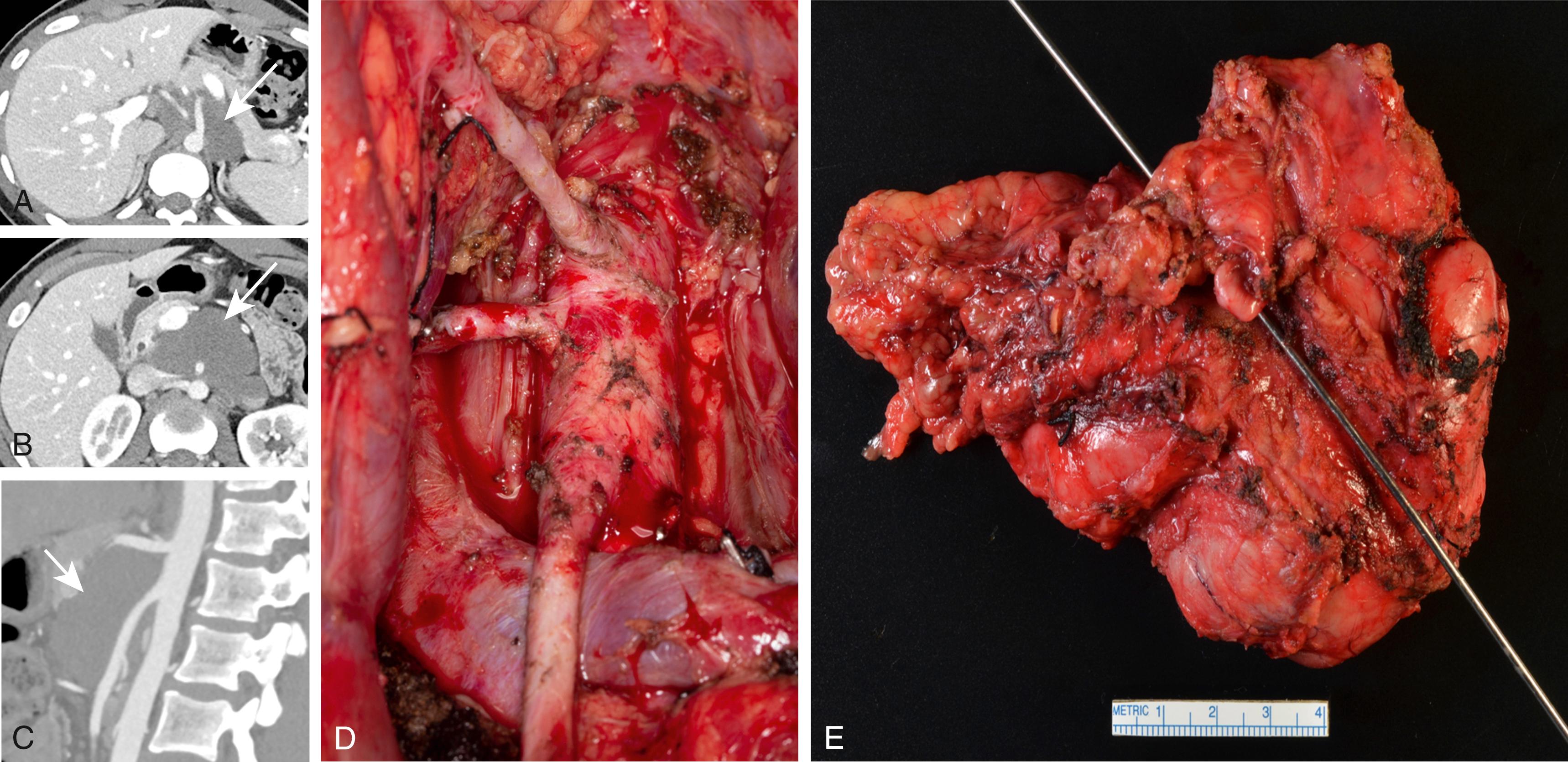 Figure 194.1, Axial ( A , B ) and sagittal ( C ) CT images of young patient with a large ganglioneuroma wrapped around the celiac, common hepatic and superior mesenteric arteries. The common hepatic artery had a separate origin from the aorta. The tumor partially encased the left renal vein and artery. Intraoperative photograph ( D ) showing the skeletonized paravisceral aorta, celiac, common hepatic and superior mesenteric arteries, and the left renal vein at the bottom of the picture. The specimen is shown in E .