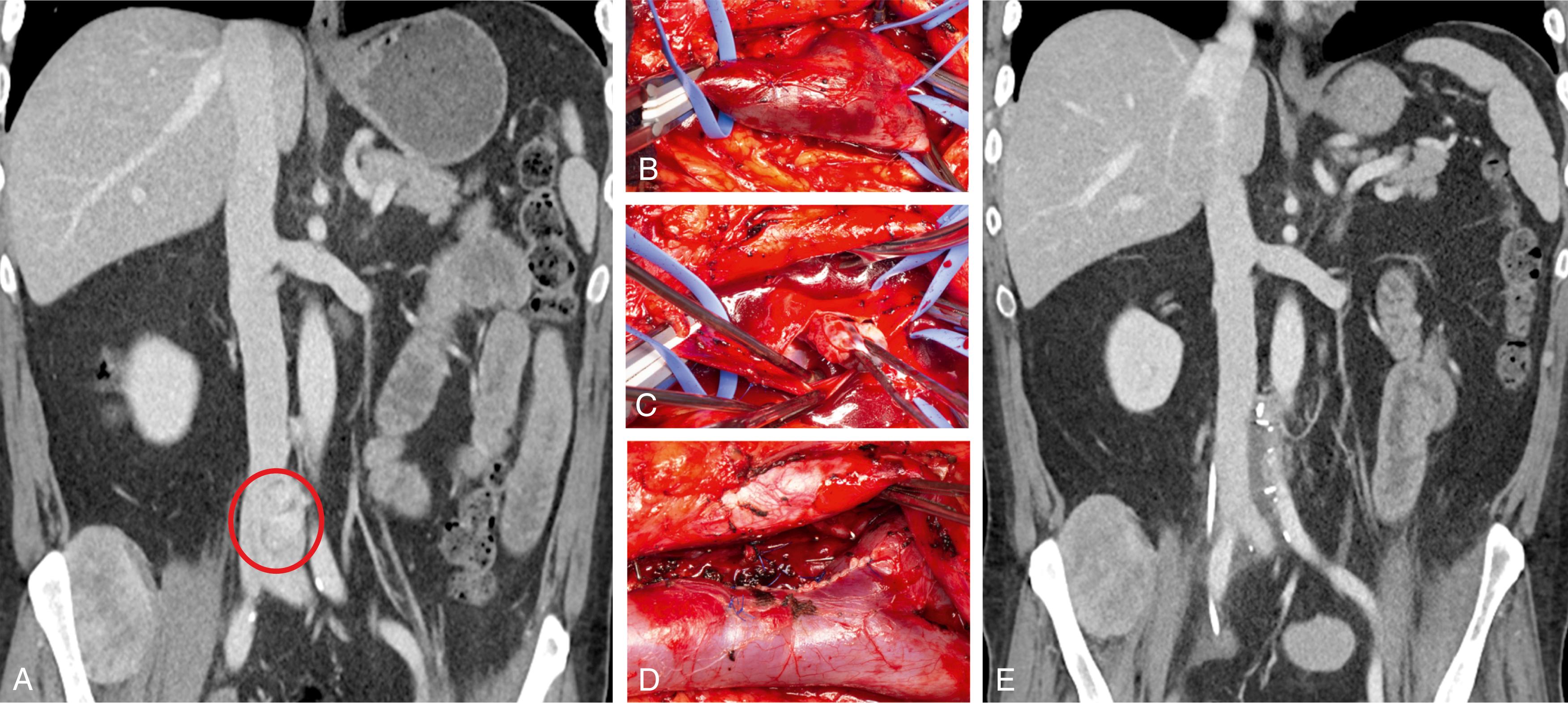 Figure 194.2, Patient with metastatic papillary thyroid cancer growing from a lumbar vein into the lower vena cava near the iliac vein–caval confluence as shown in the CT image ( A , red circle). The tumor had to be removed to allow systemic therapy to treat his disease. The tumor was removed by opening the vena cava and upper left common iliac vein on the left anterolateral wall and at the lumbar vein–caval confluence. Both the lumbar vein defect and the vena cava were closed primarily ( B–D ). Postoperative CT scan at 6 months showing a widely patent vena cava and upper common iliac veins ( E ).