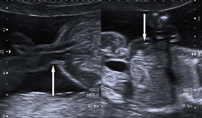 FIGURE 17-1, TS and LS (arrows) of the anterior abdominal wall demonstrating the normal cord insertion.