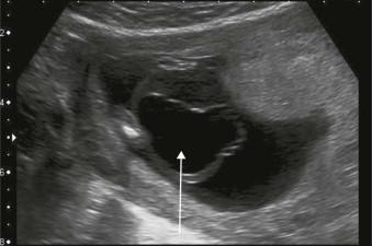 FIGURE 17-12, A large cystic mass (arrow) arising from the lower abdomen in this 14-week fetus.