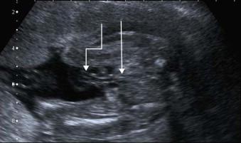 FIGURE 17-14, TS of the pelvis in a fetus with bladder exstrophy: absent bladder (line arrow) and low cord insertion (stepped arrow).