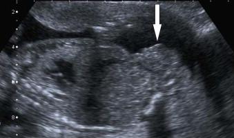 FIGURE 17-15, LS of the lower abdomen in a fetus with bladder exstrophy demonstrating the mass on the anterior abdominal wall (block arrow) which is the exteriorized everted bladder.