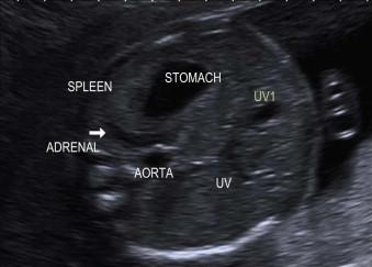 FIGURE 17-16, TS of the normal upper abdomen. UV, umbilical vein; UV1, first part of the umbilical vein.