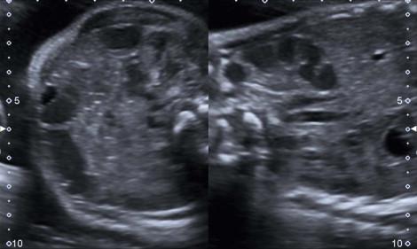 FIGURE 17-17, TS and LS of the normal small bowel in a 33-week fetus.