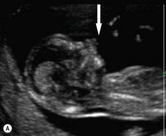 FIGURE 17-5, This fetus with a midline cleft (arrow at the premaxillary protrusion) had a small bowel-only exomphalos. Trisomy 13 was confirmed.