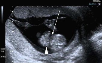 FIGURE 17-7, TS of the abdomen of a 13-week fetus showing a gastroschisis (arrowhead) on the right of the cord insertion (arrow).
