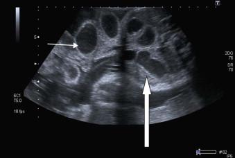 FIGURE 17-8, TS of the abdomen showing multiple distended segments of exteriorized (line arrow) and internal bowel (block arrow), confirmed closed loop postnatally.