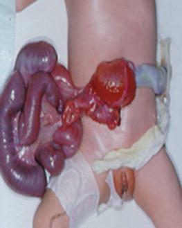 FIGURE 17-9, Postnatal image of a baby with gastroschisis.