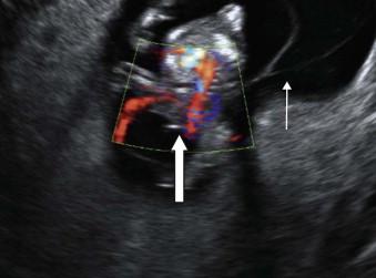 FIGURE 17-10, Transvaginal scan demonstrating a huge abdominoschisis (block arrow) and the amniotic bands (line arrow).