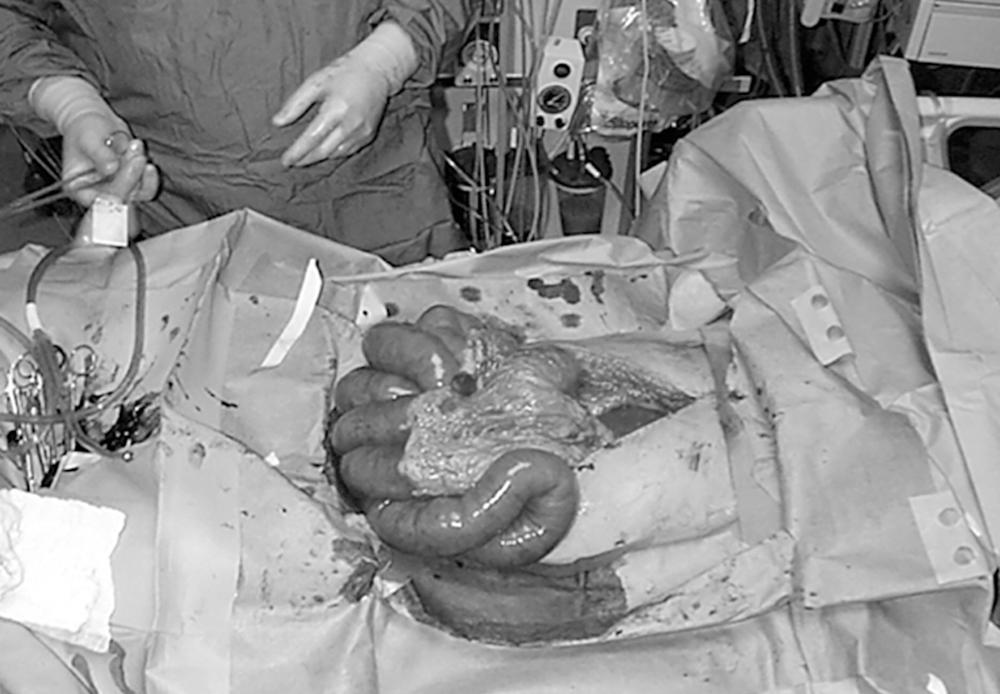 FIGURE 4, Bedside decompressive celiotomy for abdominal compartment syndrome. Note massive small bowel edema.