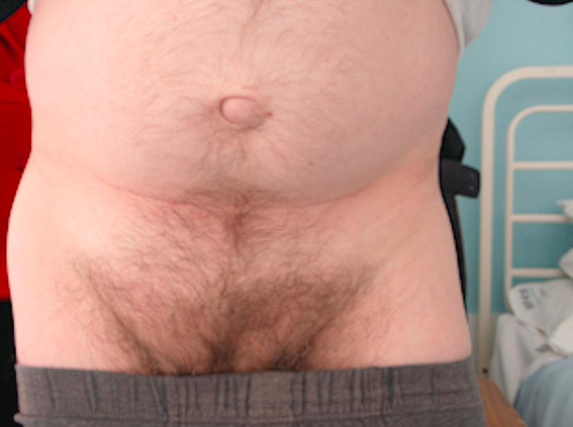 Figure 7.3, Clinical photograph of a para-umbilical hernia. Note the swelling of the right groin of an associated right inguinal hernia – a common finding consistent with a generalised collagen disorder.