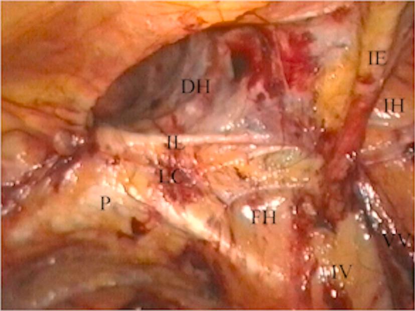 Figure 7.4, Laparoscopic totally extraperitoneal (TEP) view of the right groin with a direct inguinal hernia ( DH ) lying medial to the inferior epigastric vessels ( IE ), above the inguinal ( IL ) and lacunar ( LC ) ligaments. The pubic bone ( P ), iliac vessels ( IV ), vas and vessels ( VV ) are also seen. The positions of a femoral hernia ( FH ) and indirect inguinal hernia ( IH ) are also marked.