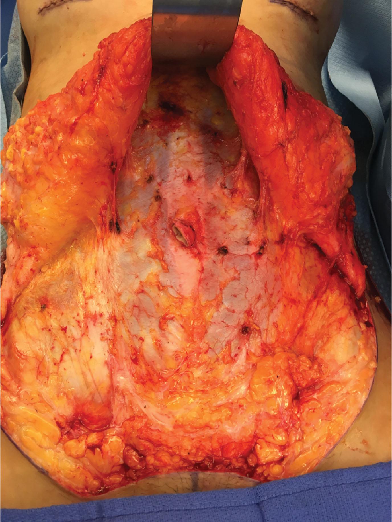 Figure 13.1, Linea alba seen both above and below umbilicus in a female undergoing an abdominoplasty for rectus diastasis.