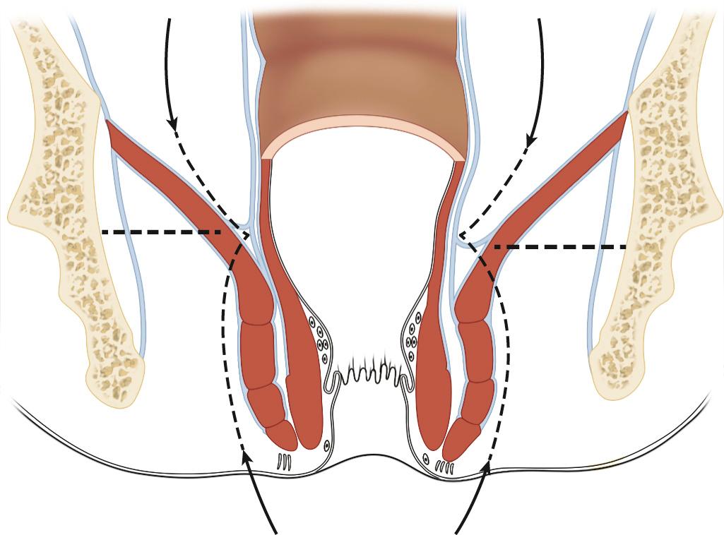 FIGURE 169.1, Traditional abdominoperineal resection. Note the potential for coning in on the resection margin at level of levators.