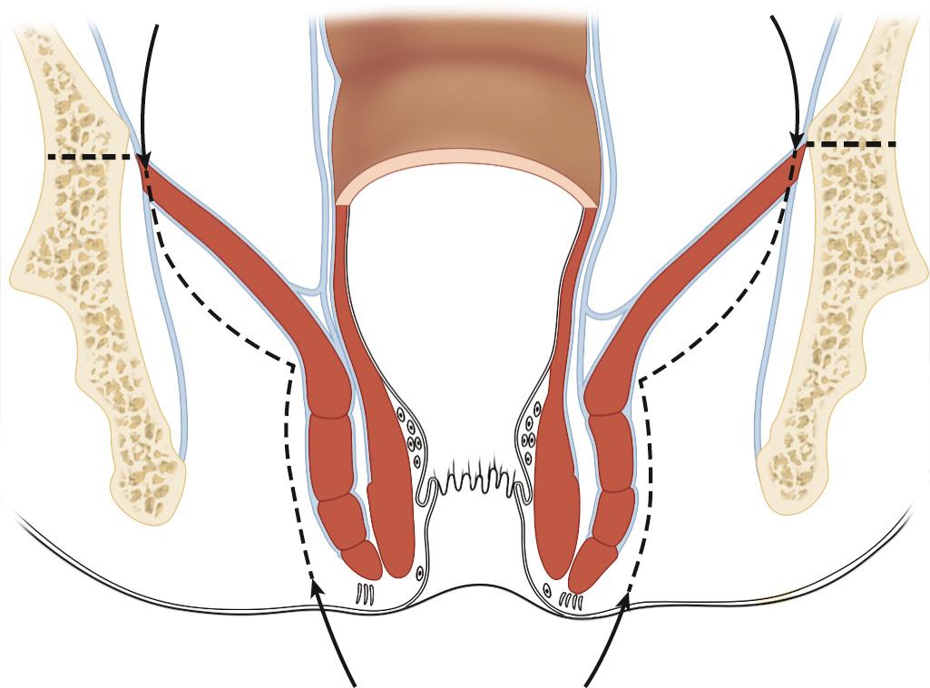 FIGURE 169.2, Extended abdominoperineal resection. Wider transection of the levators, resulting in a cylinder of tissue around the tumor but leaving a larger pelvic floor defect.