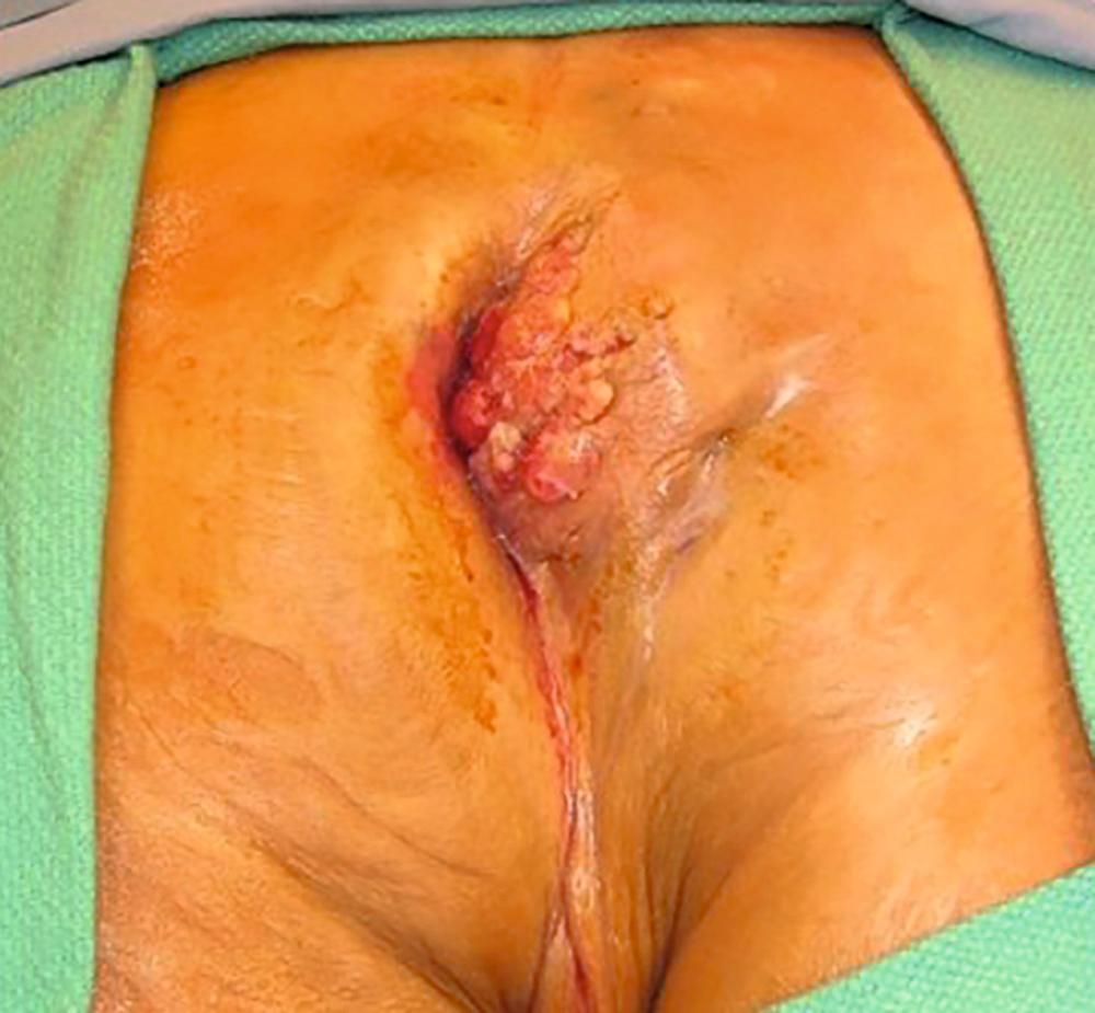 FIGURE 169.5, Low rectal tumor with extensive ischioanal involvement.