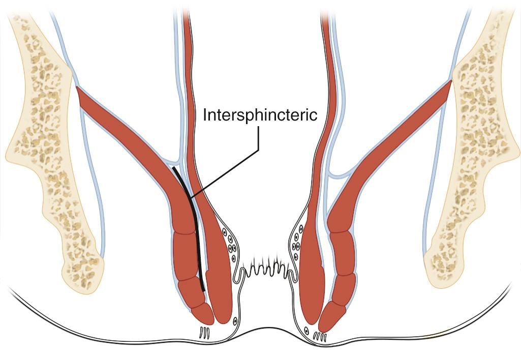 FIGURE 169.6, Intersphincteric approach.