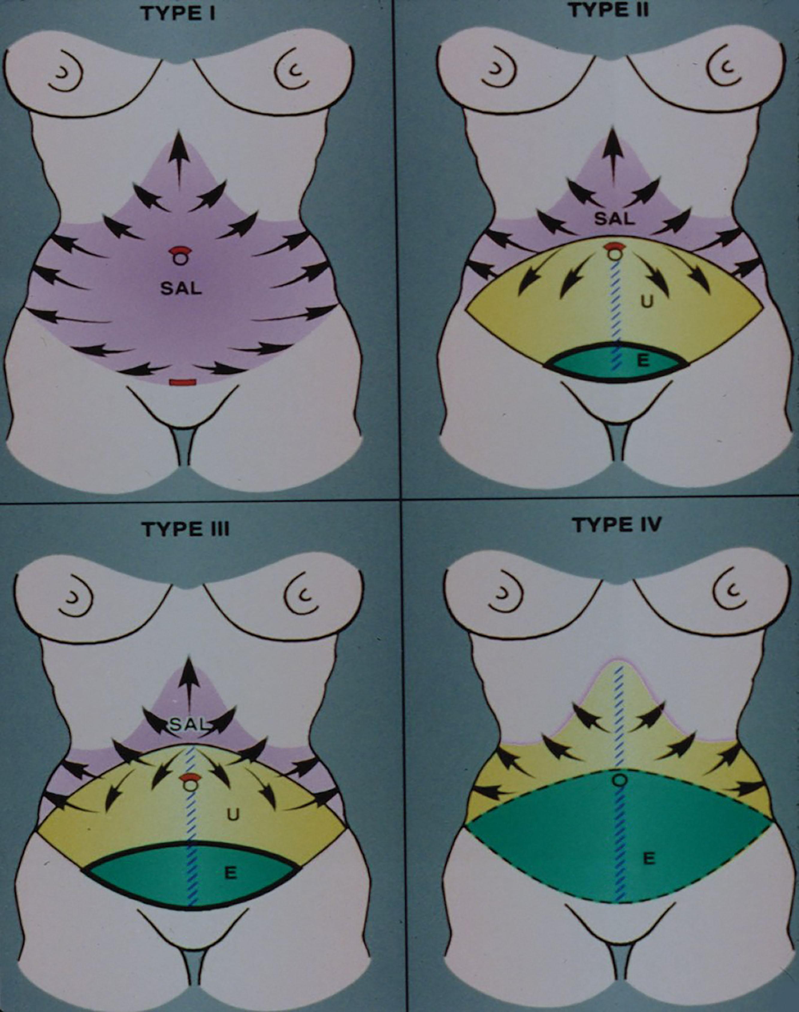 Figure 27.1, The abdominoplasty system of classification and treatment. The common abdominal procedures: type I, liposuction; type II, mini-abdominoplasty; type III, modified abdominoplasty; type IV, full abdominoplasty with liposuction (lipoabdominoplasty) or without liposuction. E , Excision; SAL , suction-assisted lipectomy; U , undermining.