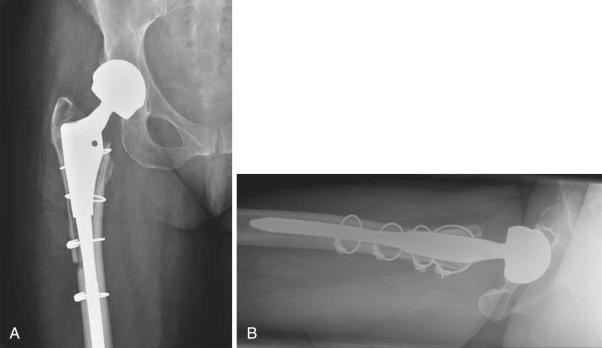 Fig. 108.1, (A) Anteroposterior and (B) lateral radiographs show an extended trochanteric osteotomy that united with multifilament cables alone.