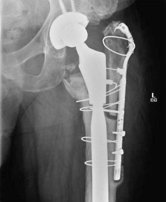 Fig. 108.3, Anteroposterior hip radiograph shows an ununited extended trochanteric osteotomy despite use of a long cable-plate system.
