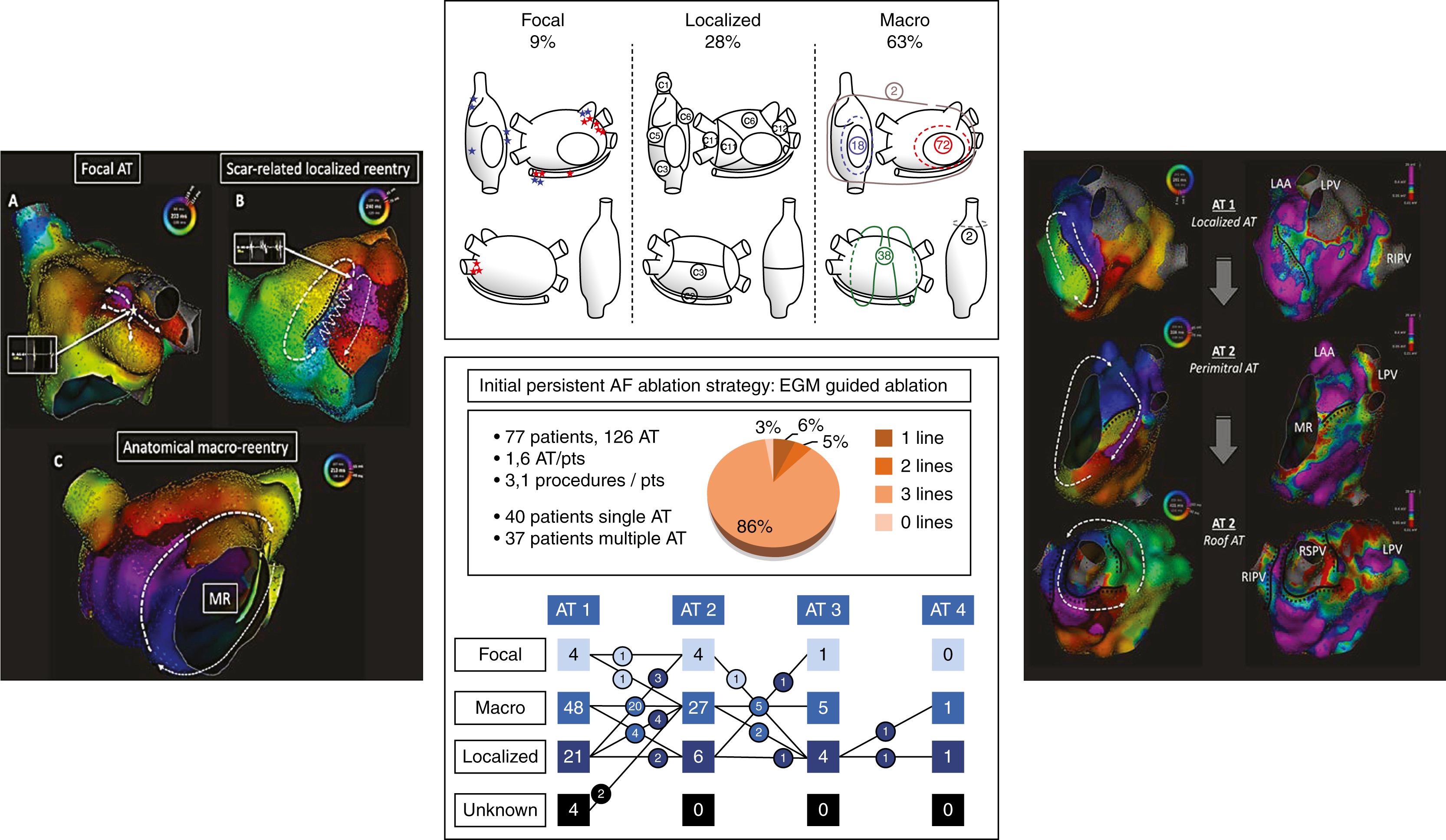 Fig. 76.2, Complex atrial tachycardia (AT) after electrical substrate ablation.