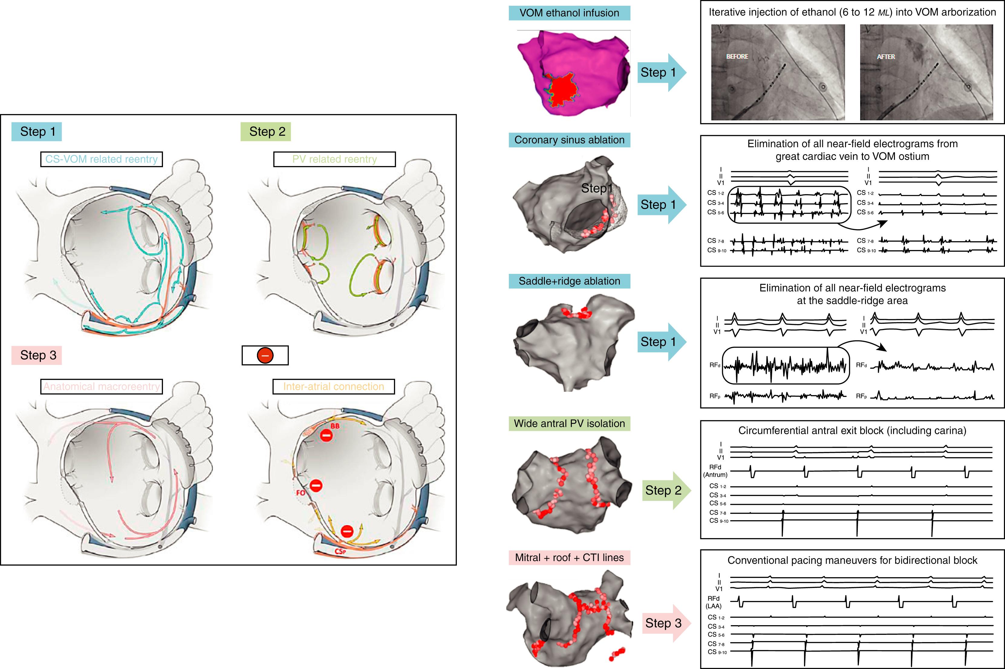 Fig. 76.3, Anatomic approach proposed by our group.