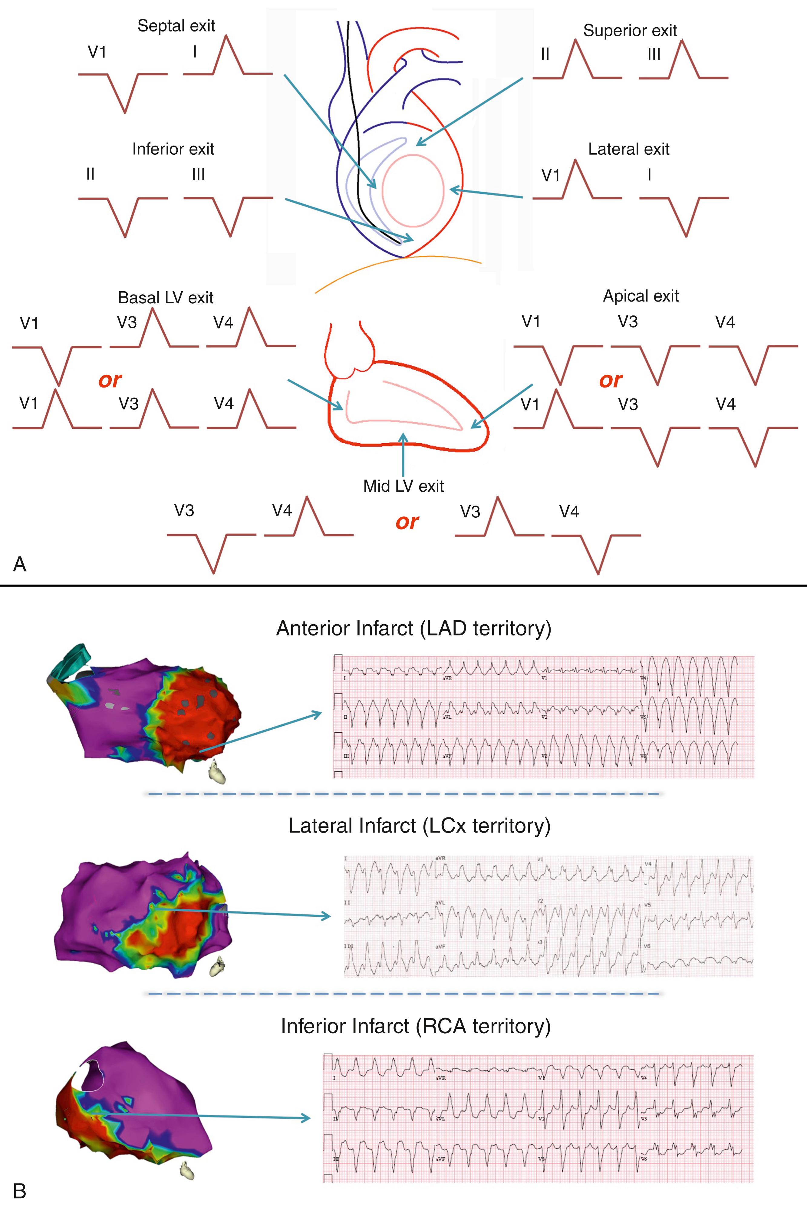 Fig. 86.1, Ventricular tachycardia exit site localization algorithm.