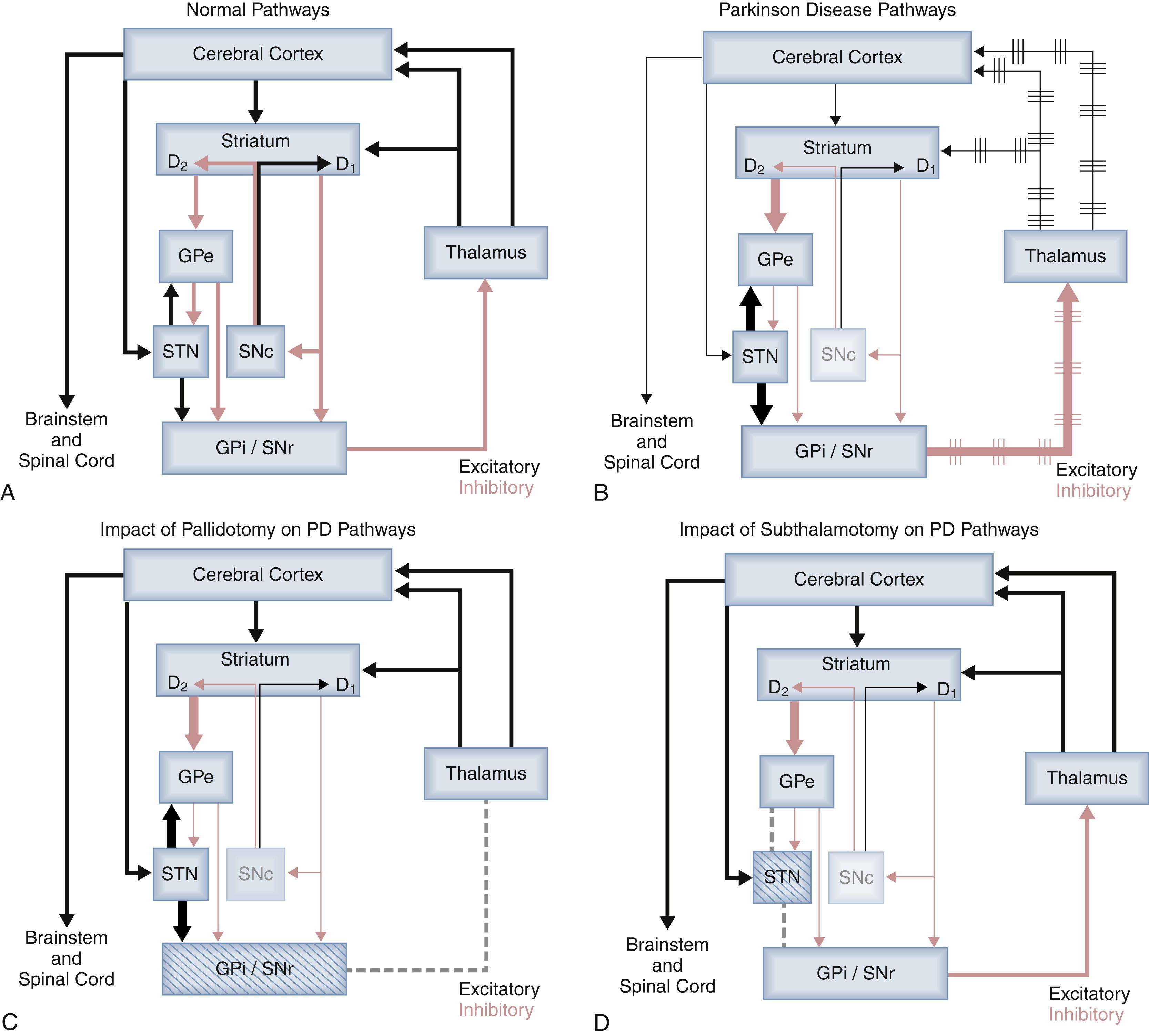 Figure 110.1, Basal ganglia circuitry relevant to Parkinson disease and its surgical treatment.