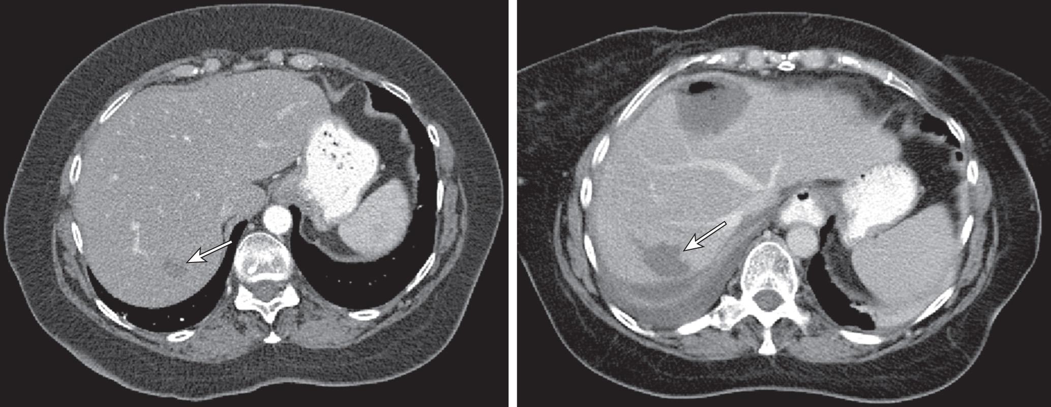 FIGURE 126.1, Computed tomography scan of a liver tumor before (left; arrow) and 1 month after (right; arrow) radiofrequency ablation.