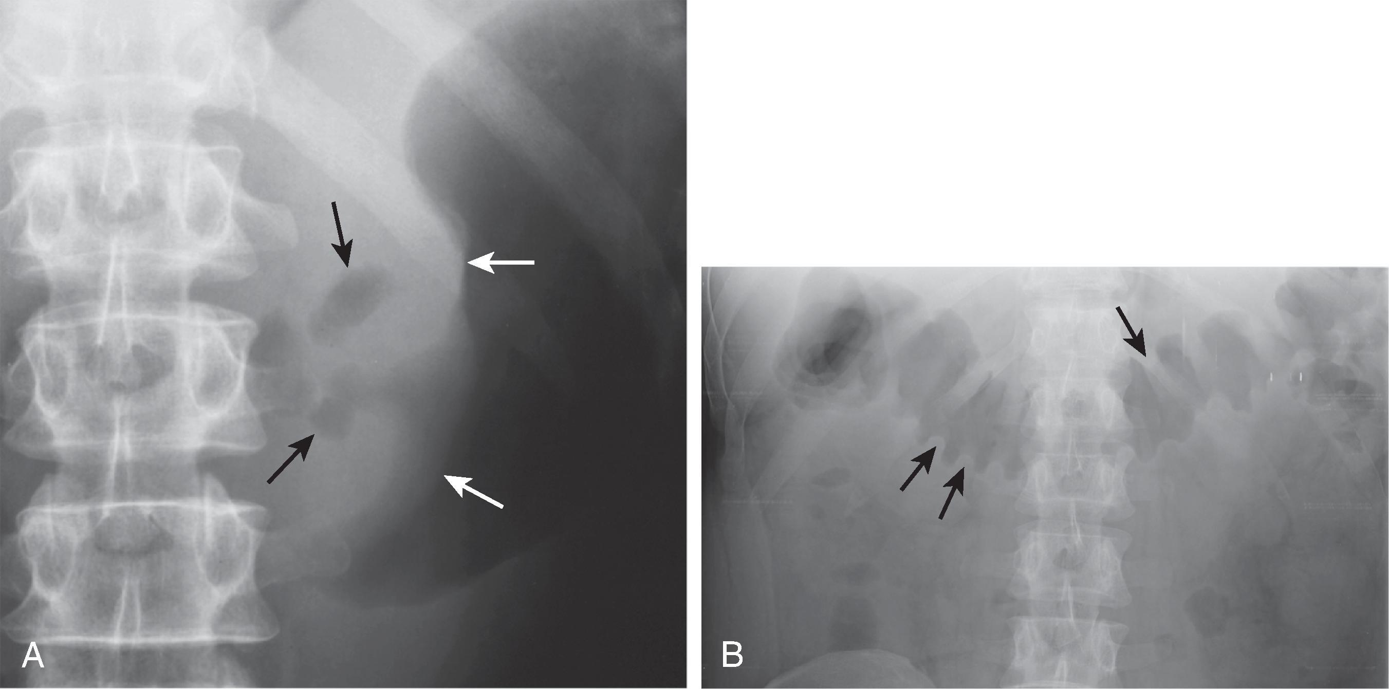 Fig. 2.1, Abnormal bowel contours. (A) Gas in the stomach outlines a mass ( white arrows ) on the lesser curvature, with an irregular central gas collection ( black arrows ) representing a large benign ulcer with surrounding edema. (B) Air in the transverse colon outlines thickened haustral folds ( arrows ) in a patient with colonic ischemia. (A, Courtesy Timothy J. Cole, MD, Richmond, VA.)