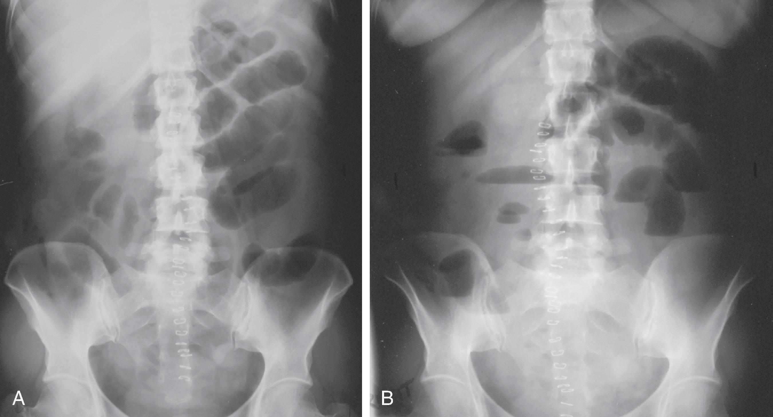 Fig. 2.2, Postoperative ileus mimicking small bowel obstruction. (A) Supine abdominal radiograph shows multiple loops of dilated small bowel with a paucity of colonic gas. (B) Upright radiograph shows multiple air-fluid levels. Although the radiographic findings are suggestive of small bowel obstruction, this patient had a postoperative ileus involving the small bowel (note the longitudinal row of skin staples from recent abdominal surgery).