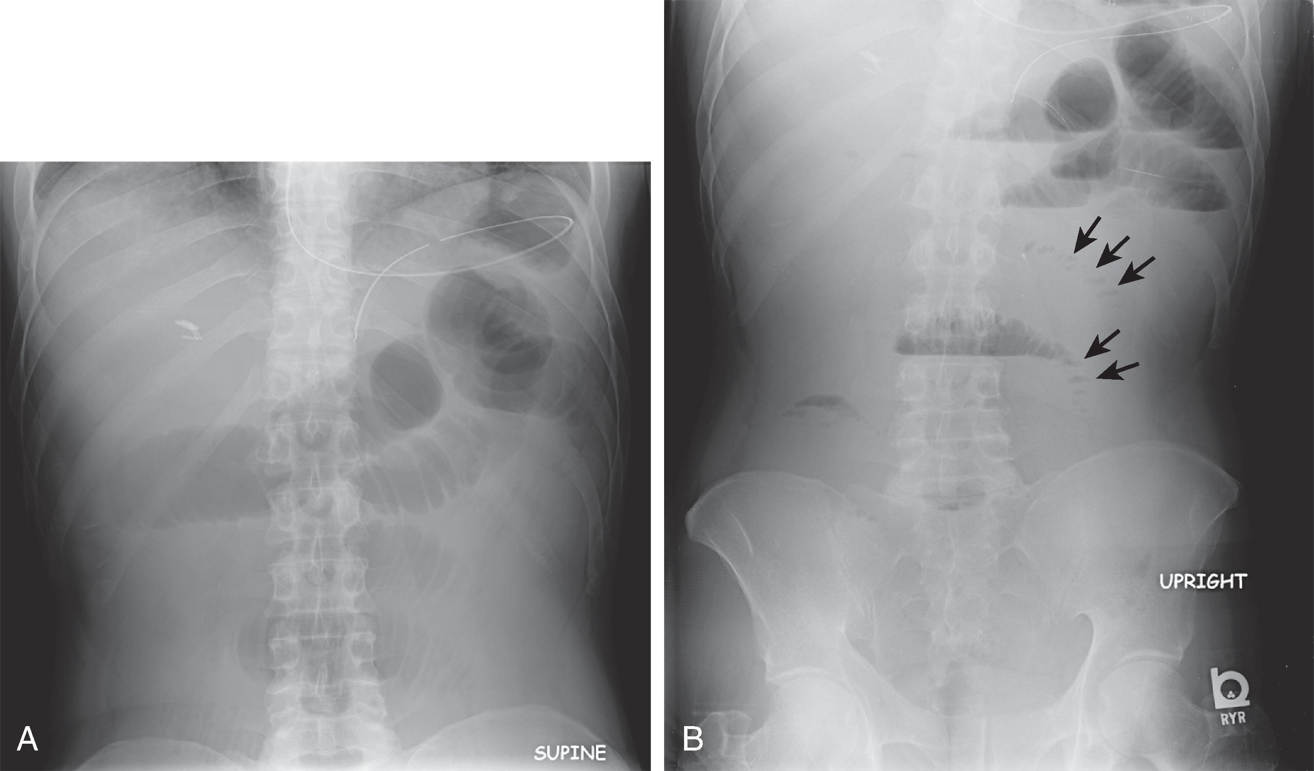 Fig. 2.3, Small bowel obstruction. (A) Supine abdominal radiograph shows dilated small bowel loops in the upper abdomen with a paucity of colonic gas. (B) Upright radiograph demonstrates multiple air-fluid levels. Small amounts of gas trapped between small bowel folds in the left midabdomen ( arrows ) produce the string of pearls sign.