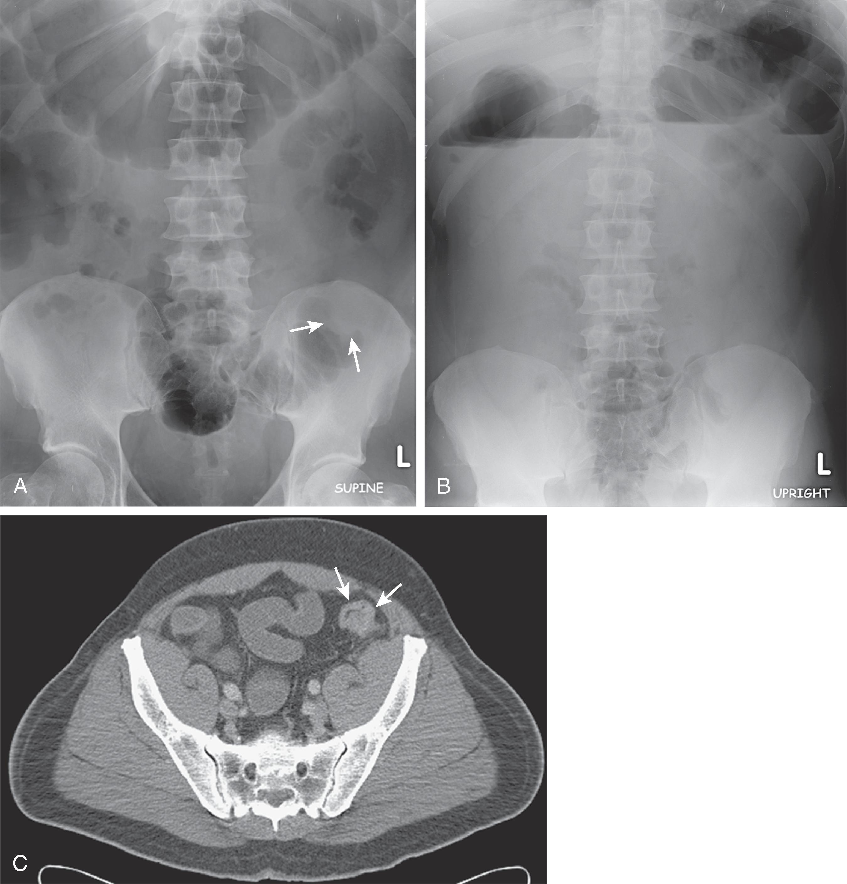 Fig. 2.4, Colonic obstruction caused by colonic carcinoma. (A) Supine abdominal radiograph shows dilated colon with a soft tissue mass ( arrows ) in the sigmoid colon and a paucity of gas in the rectum. (B) Upright radiograph shows air-fluid levels in the colon proximal to the site of obstruction. (C) Computed tomography confirms the presence of a mass ( arrows ) in the sigmoid colon.