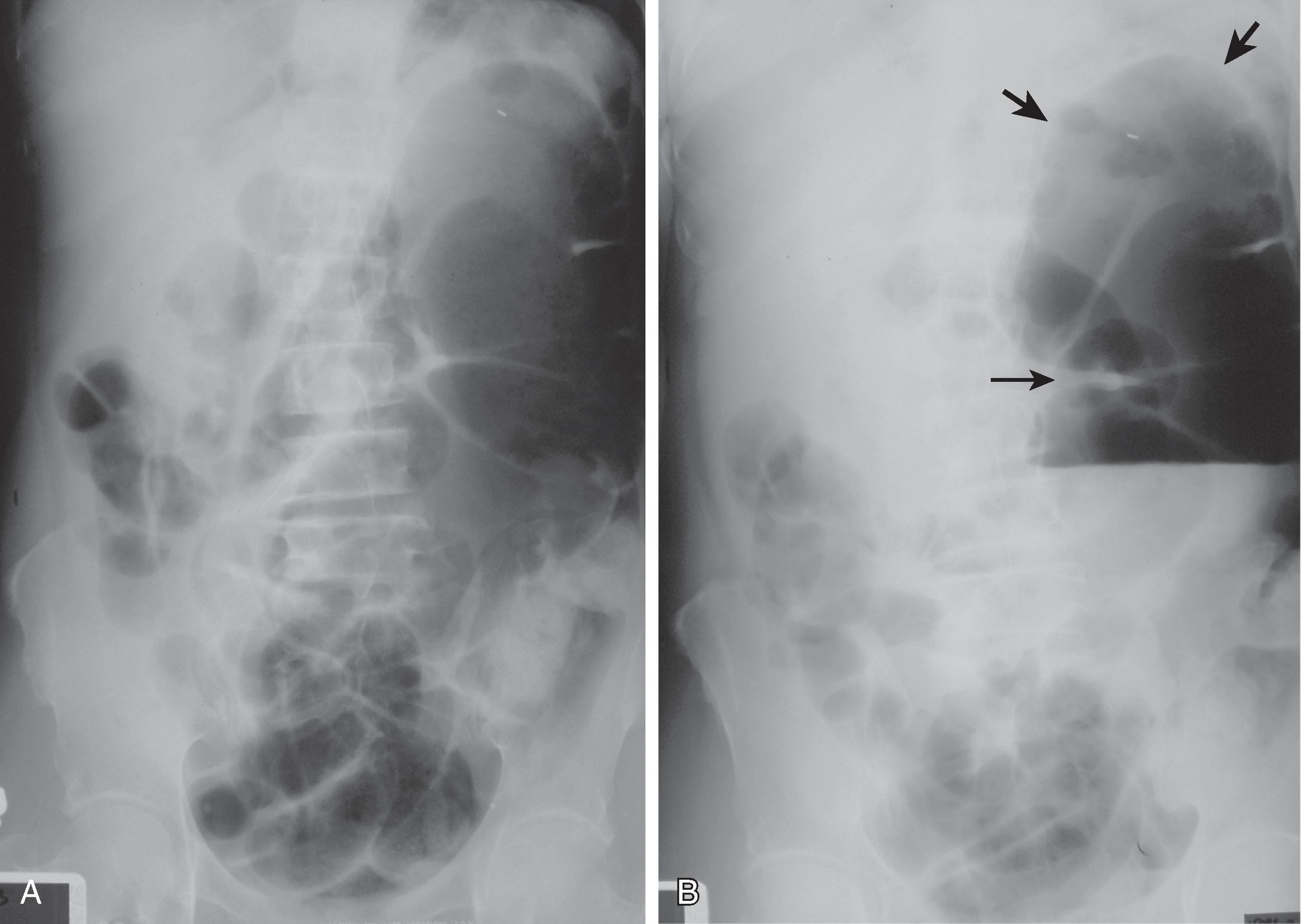 Fig. 2.6, Cecal volvulus. (A) Supine abdominal radiograph shows a markedly dilated viscus in the left upper quadrant, representing the obstructed cecum. Also note multiple loops of dilated small bowel. (B) Upright radiograph shows the caput of the cecum superiorly ( small thick arrows ) and ileocecal valve ( long thin arrow ), with a single air-fluid level in the dilated cecum. These findings are characteristic of cecal volvulus.