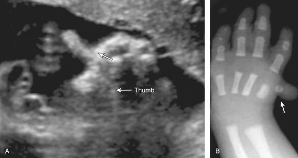 Fig. 61.1, (A) Hitchhiker thumb at 20 weeks' gestation. Arrow points to radially deviated thumb. (B) Radiograph of the hand from the same fetus, showing deviated thumb (arrow) .
