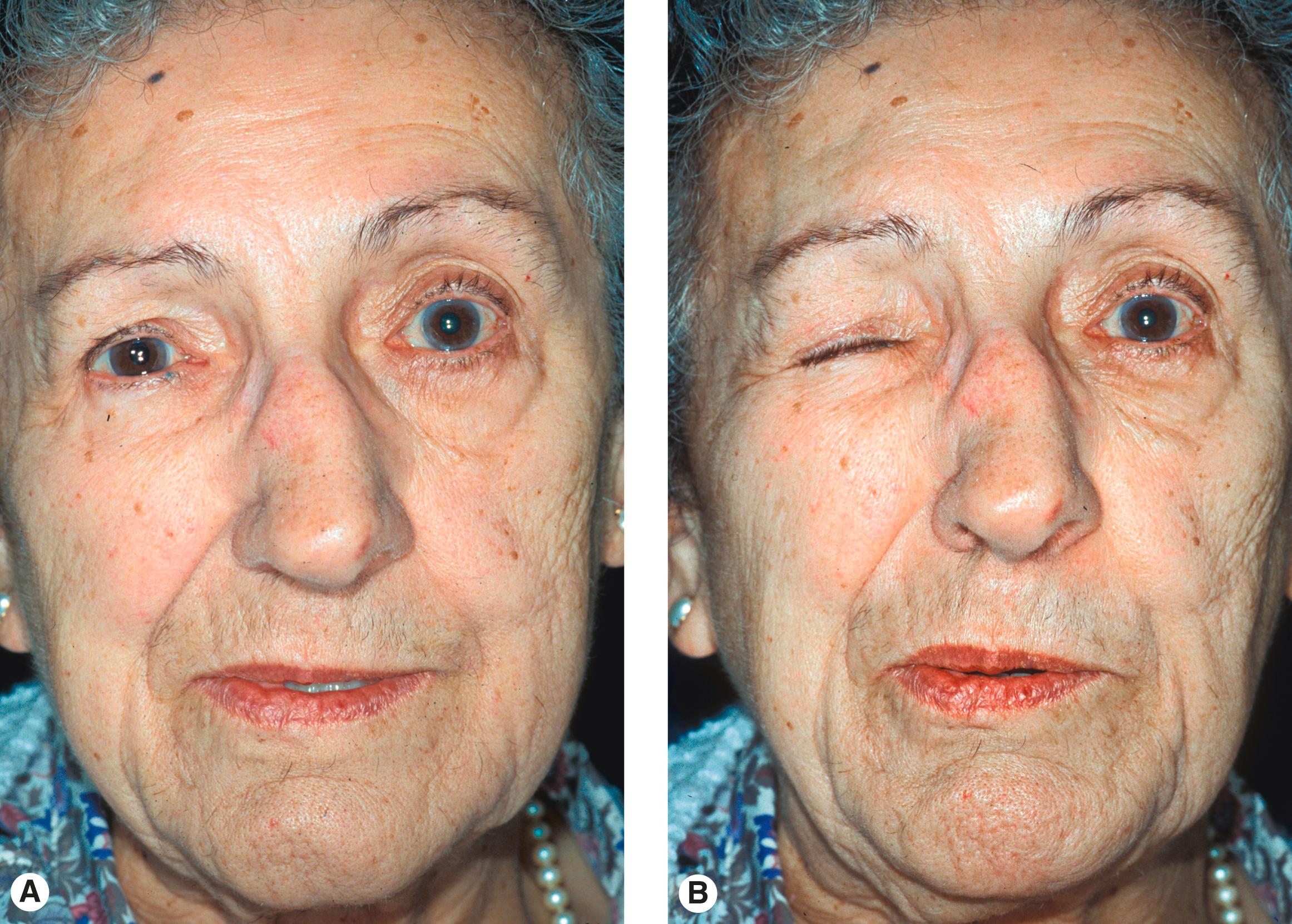 Figure 9.2, Aberrant regeneration of the facial nerve. ( A ) Right facial nerve palsy with mild tonic contracture of the right facial muscles. ( B ) Note that the palpebral fissure narrows with lip pursing.