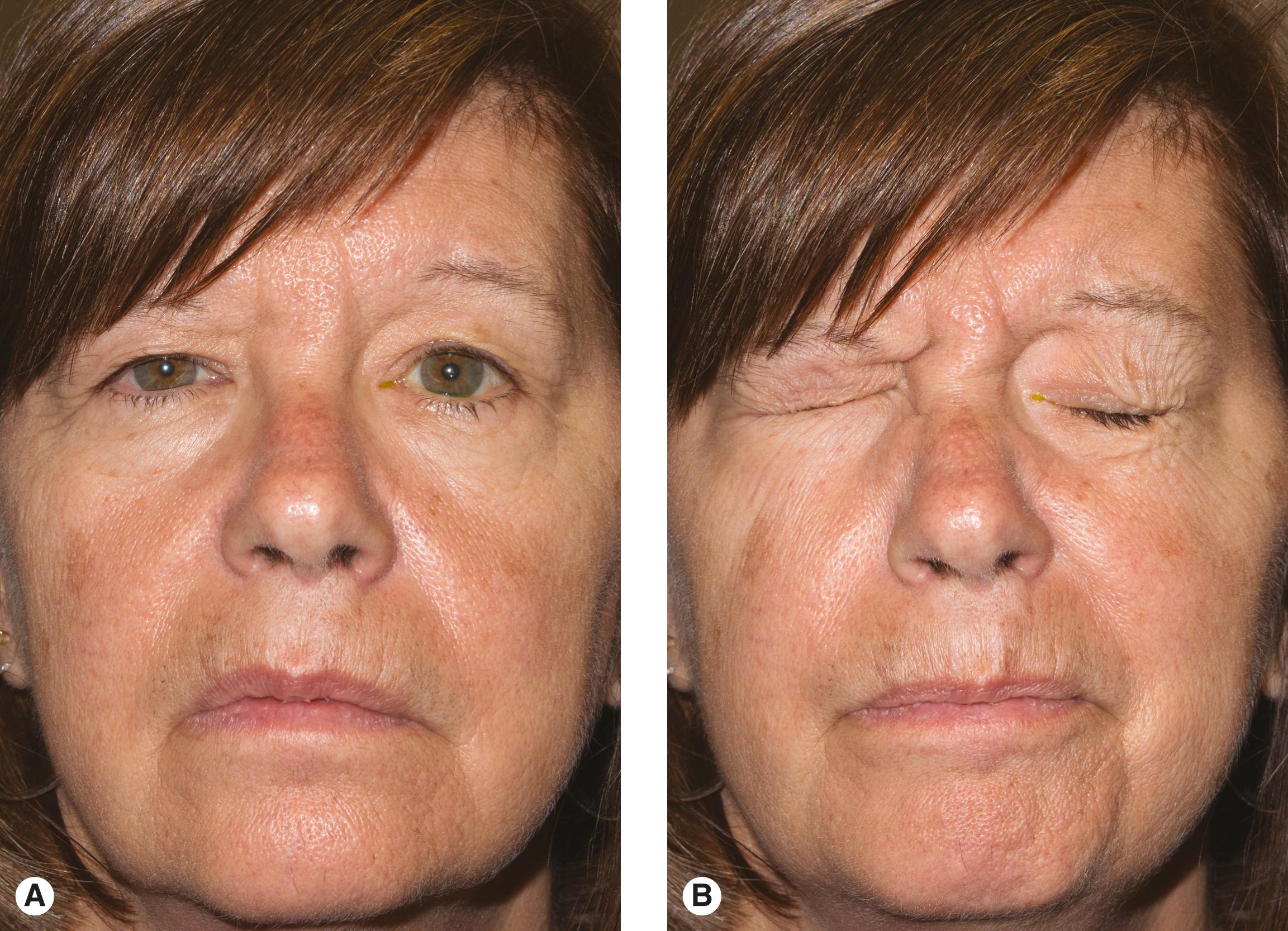 Figure 9.3, Left facial nerve (idiopathic Bell palsy). ( A ) Patient at rest. If you are really observant, you notice some asymmetry at rest; there is slight drooping of the corner of the mouth, the left eye is open more, and the left brow is higher (because the orbicularis tone is decreased). ( B ) Forceful closure of the eyelids. Notice asymmetry of the closure. The eyelashes are not buried on the patient’s left eye. With the facial muscles exaggerated, you probably have noticed the aberrant regeneration of the cheek (the melolabial fold is tensed and the mouth is drawn upward). The left brow does not drop; this is part of the aberrant regeneration of the frontalis muscle. Despite all this overactivity of the facial nerve, the eyelid closure is weakened!