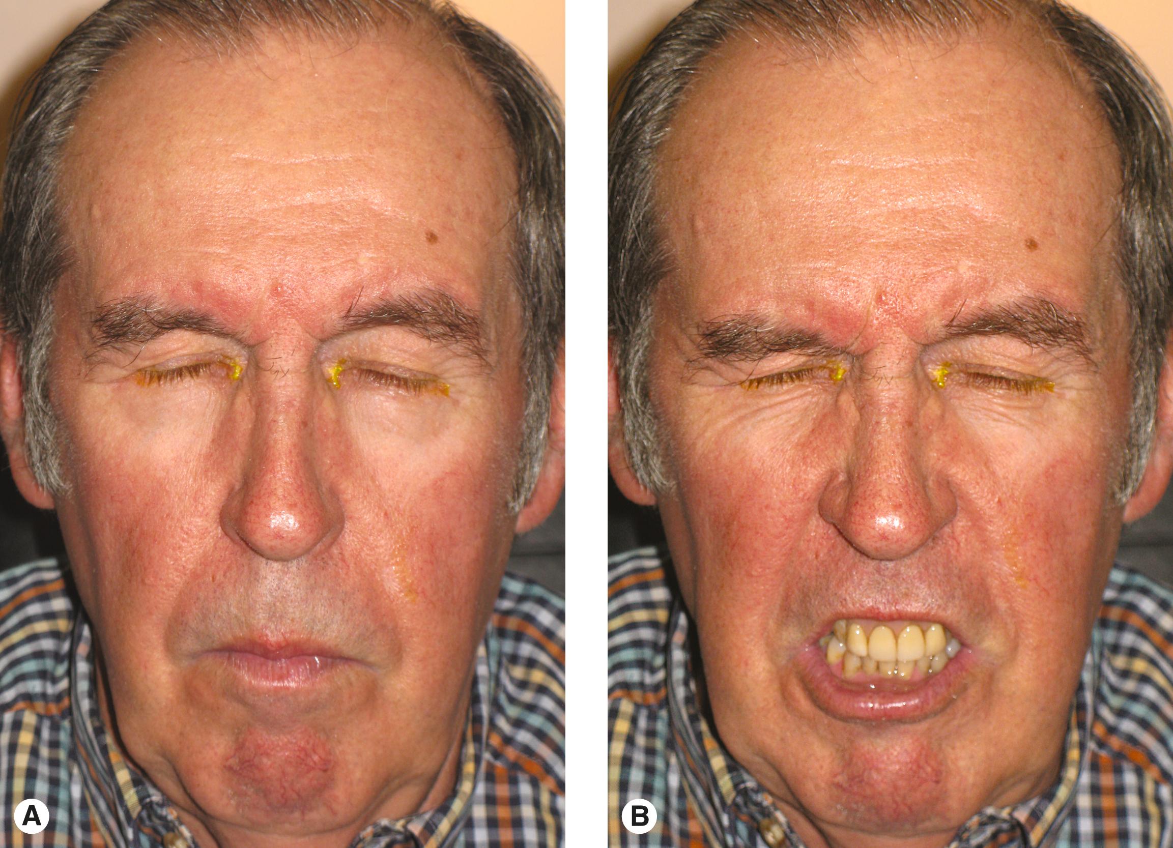 Figure 9.7, A late stage of the essential blepharospasm spectrum: apraxia of eyelid opening and Meige syndrome. ( A ) Bilateral involuntary closure of the eyes with little spasm at this point, suggesting an element of apraxia. ( B ) The associated grimacing of the lower face, diagnostic of Meige syndrome.