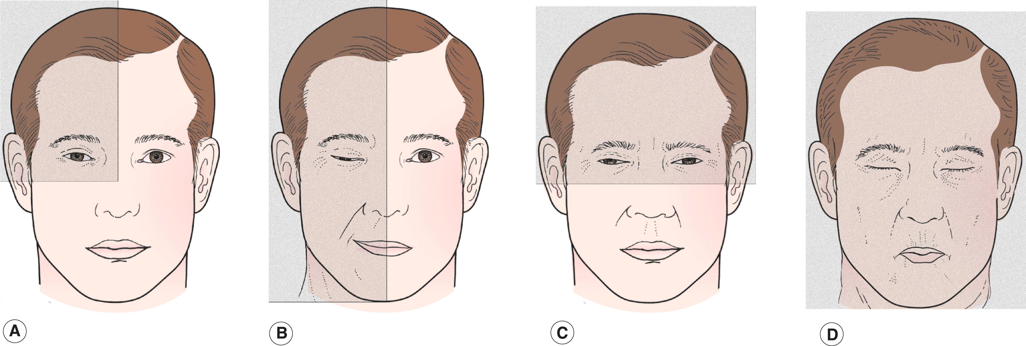 Figure 9.9, The diagnosis of facial spasm. Divide the face into quadrants to determine the diagnosis. ( A ) Orbicularis myokymia: one quadrant of face; spasm limited to a few muscle fibers on the upper or lower lid. ( B ) Hemifacial spasm: two quadrants, entire side of face; intermittent spasm of one side of the face, including all branches of the facial nerve. Look for subtle involvement of the chin, neck, and brow. ( C ) Essential blepharospasm: two quadrants, upper half of face; bilateral involuntary closure or spasm of eyelids, including orbital orbicularis and corrugator superciliaris. ( D ) Meige syndrome: four quadrants, entire face and often neck; essential blepharospasm and lower facial involvement, pursing of lips is common.