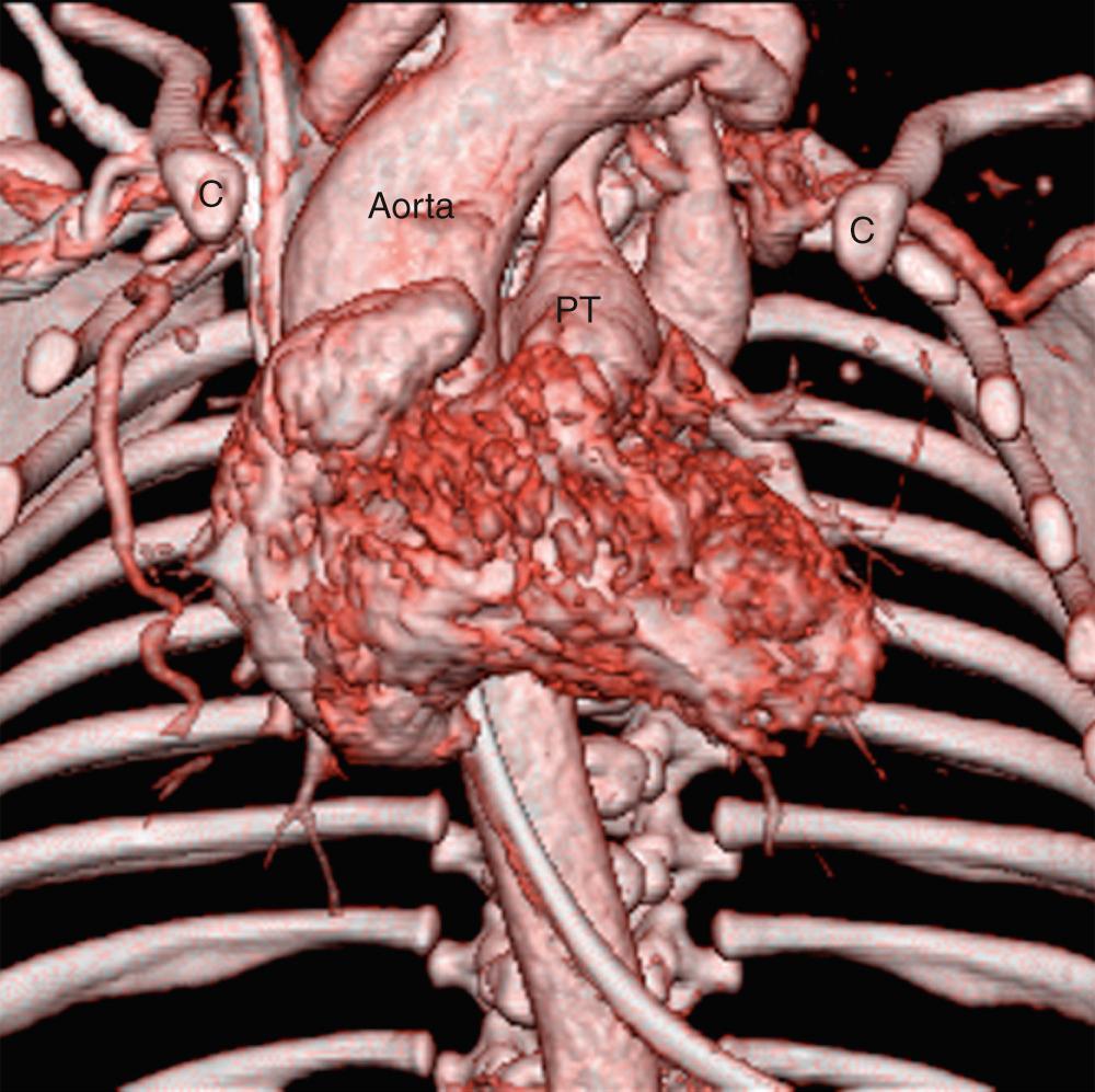 Fig. 49.1, Computed tomographic reconstruction showing the abnormal location of the heart in the setting of the absence of the sternum. There is a cervical aortic arch. C, Clavicle; PT, pulmonary trunk.