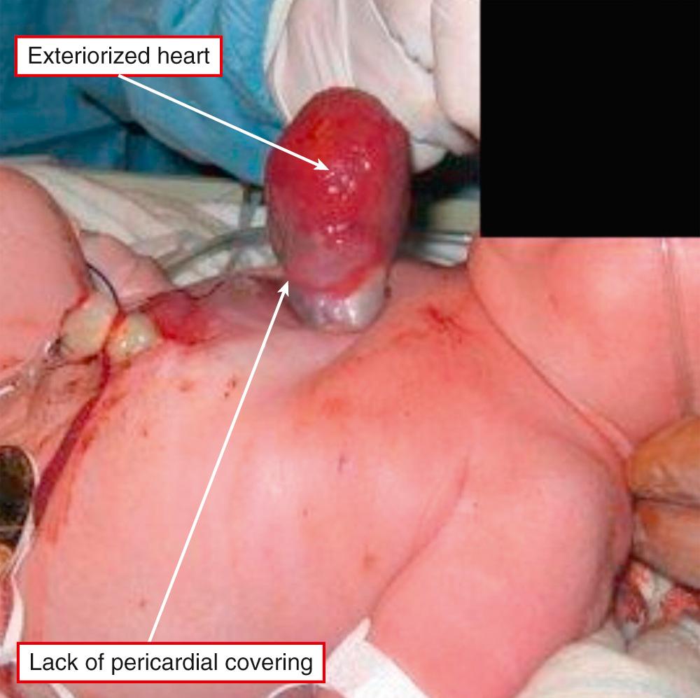 Fig. 49.2, Neonate with the heart exteriorized through the thoracic wall. Note the lack of any pericardial covering. In this instance, the heart was safely placed within the thoracic cavity.