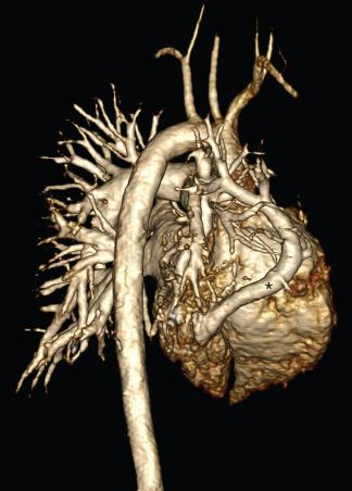 Figure 71.5, Scimitar syndrome.