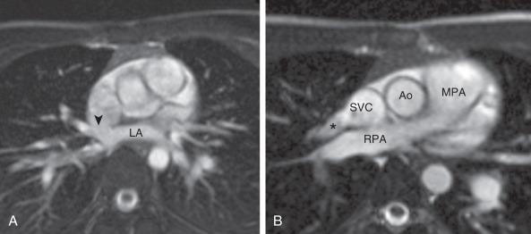 e-Figure 71.4, Sinus venosus defect with partial anomalous pulmonary venous return.