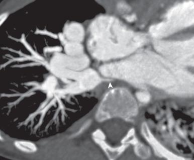 e-Figure 71.6, Severe right pulmonary vein stenosis.