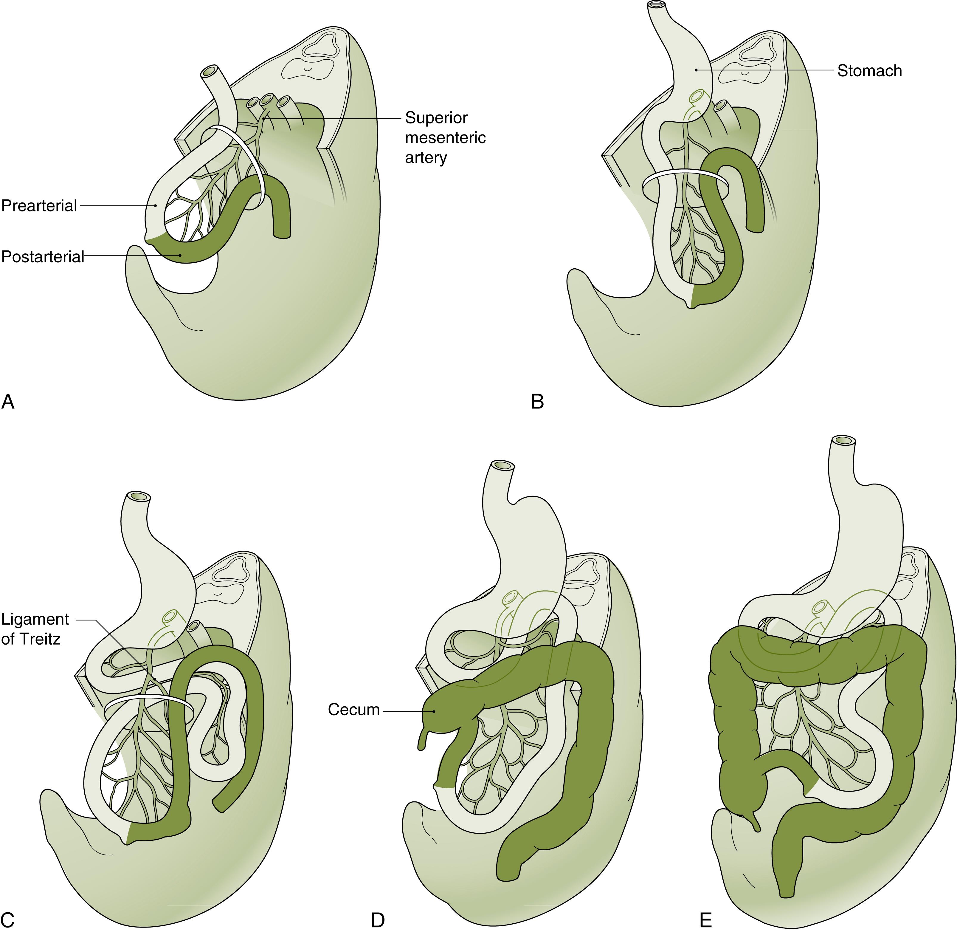 Fig. 56.1, Normal intestinal rotation of the duodenum, small intestine, and cecum from the 5th gestational week through completion by the 12th gestational week. (A) The fifth gestational week herniation of the midgut loop along the axis of the superior mesenteric artery (SMA). (B) The prearterial limb rotates counterclockwise 180 degrees, passing posterior to the SMA. (C) The distal prearterial segment passes posterior and left, rotating 270 degrees counterclockwise to become the third and fourth portions of the duodenum. (D to E) The postarterial limb, which gives rise to the cecum and right colon, rotates counterclockwise 270 degrees, placing the cecum in its final position in the right lower quadrant.